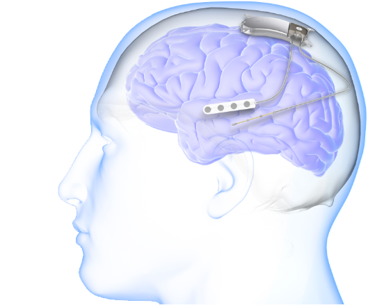 graphic of brain with RNS system device